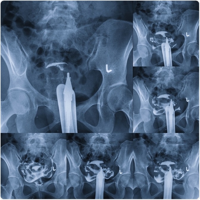 Hysterosalpingography - type of X-ray called fluoroscopy that looks at a woman's uterus and fallopian tubes. Image Credit: MossStudio / Shutterstock